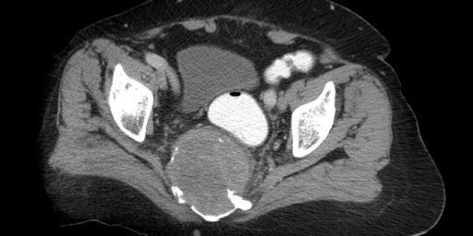 Bel Fıtığı Şikayetiyle Gittiği Hastanede Oturak Kemiğinde 10 Santimetrelik Tümör Çıktı