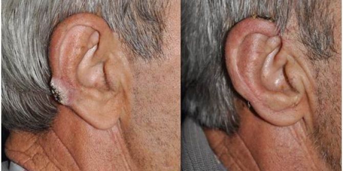 Salihli Devlet Hastanesi, Cilt Kanseri Hastalarına Umut Oldu