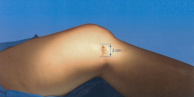 Ncr’de By-pass Damarı Çıkarılırken Bacakta Kesi İzi Kalmıyor