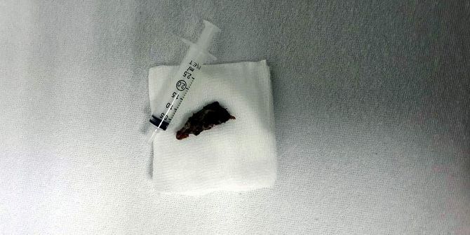 Soluk Borusundan 2,5 Santimlik Yabancı Cisim Çıkartıldı