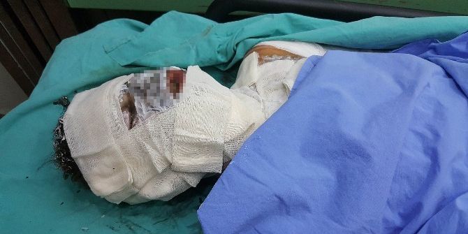 Sobaya Dökülen Tiner Parladı, Lise Öğrencisi Hastanelik Oldu