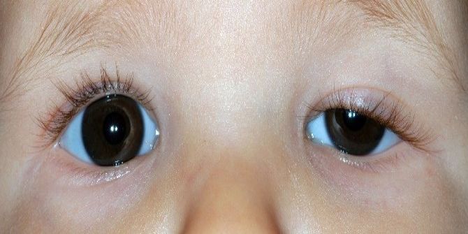 Çocuklarda Göz Kapağı Düşüklüğüne Dikkat