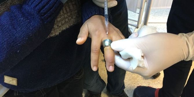 Çocuğun Parmağına Sıkışan Yüzük Hastanede Çıkartıldı