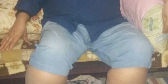 Fil Hastalığına Yakalanan 6 Çocuk Babası Yardım Bekliyor