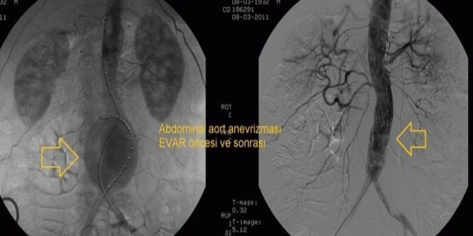 Aort Damarındaki Genişleme İçin "Evar" Tedavisi