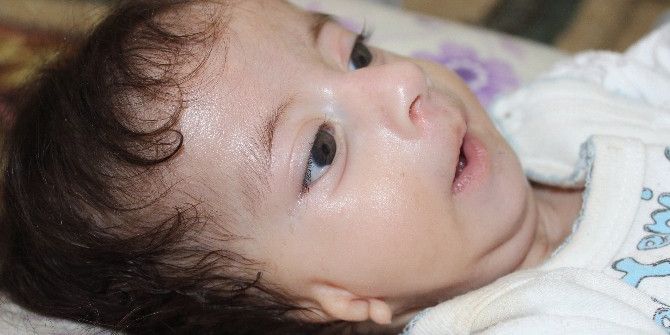 Kulakları Olmayan Bebek Ameliyat Olmayı Bekliyor