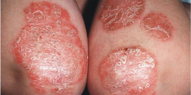 Sedef Hastalığının Nedenleri Ve Belirtileri