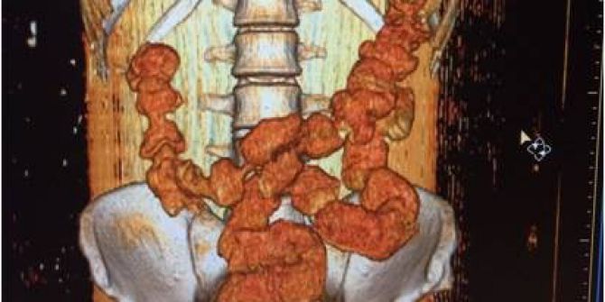 Sindirim Siteminden Uyuşturucu Çıktı