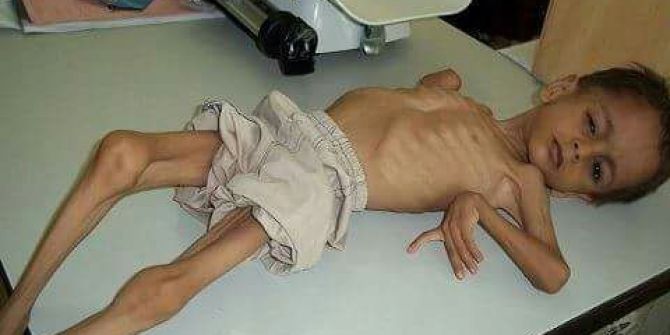 Birleşmiş Milletler, Bu Yıl Yemen’de Açlık Tehlikesi Uyarısında Bulundu