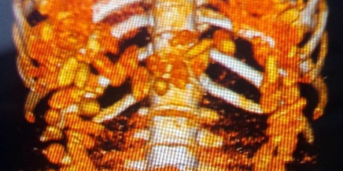 Uyuşturucu Kaçakçısının Sindirim Sisteminde 1 Kilo 300 Gram Kokain Çıktı