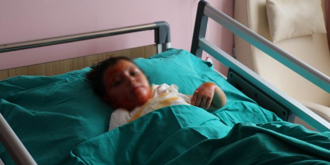 Halep’te Soba Yakarken Yanan Kardeşler Sivas’ta Tedavi Görüyor