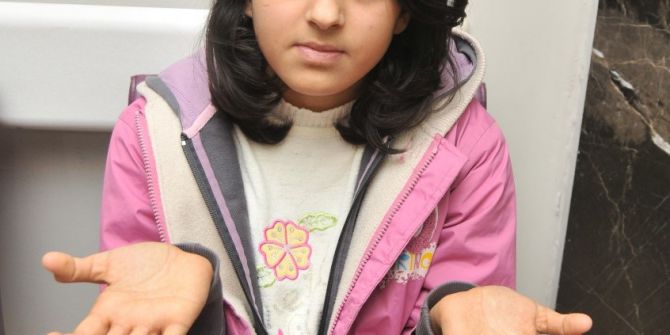 Katarakt Ameliyatı Oldu, Ellerine Çok Şaşırdı