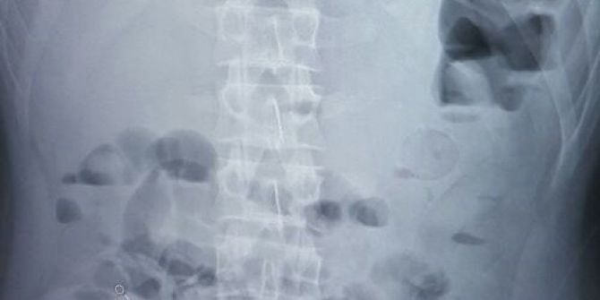 Midesine 1 Kilo 37 Gram Eroin Sığdırdı