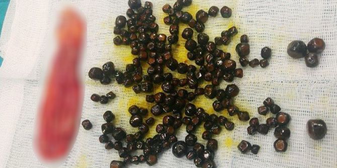 Safra Kesesinden 200 Tane Taş Çıkardılar