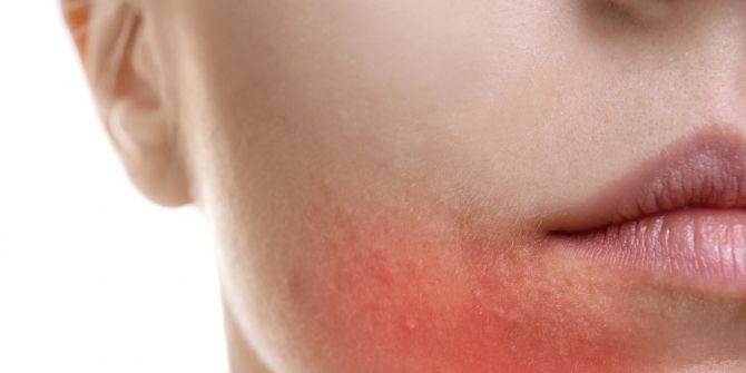 Akneye Yol Açan 10 Önemli Neden