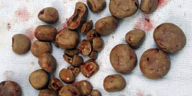 İdrar Torbasından 300 Gram Ağırlığında 40’ın Üzerinde Taş Çıkartıldı