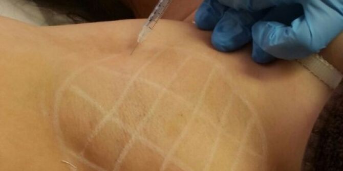 Koltuk Altı Terlemesine Botokslu Çözüm