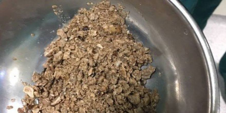 Böbrek Değil Taş Ocağı