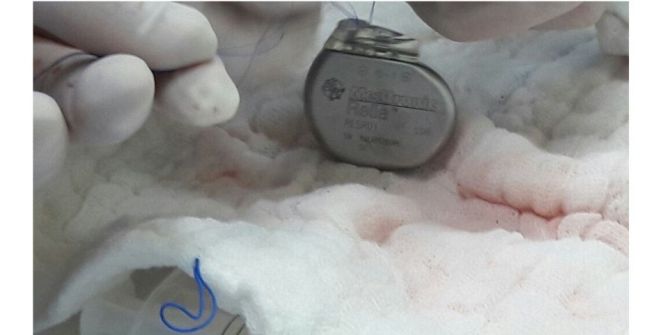 Karaman Devlet Hastanesinde İlk Kez Kalp Pili Takıldı