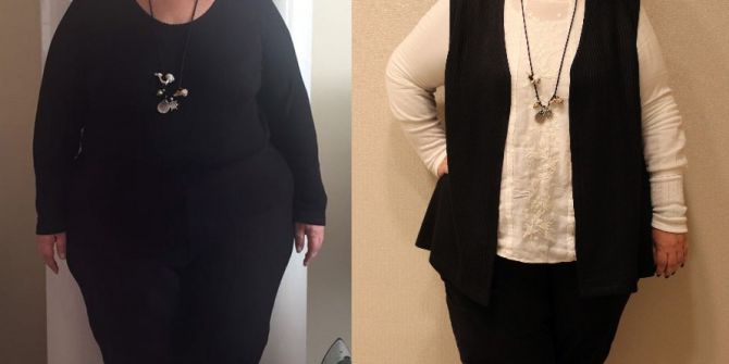 Tüp Mide Ameliyatıyla Artık Daha Sağlıklı