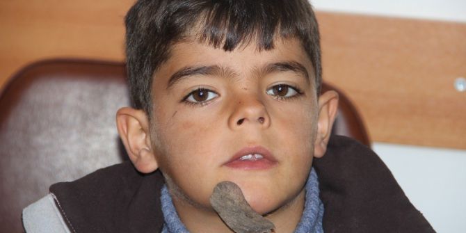 Çenesinde Tümör Olan Çocuğa Kaymakam Sahip Çıktı