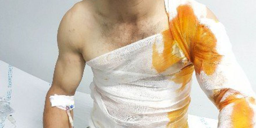 Benzinle Ateş Yakmak İsterken Yanarak Hastanelik Oldu