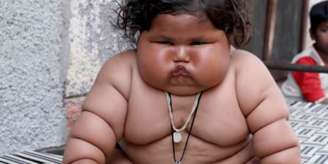 Hindistan’da 8 Aylık Bebek 17 Kilo Ağırlında