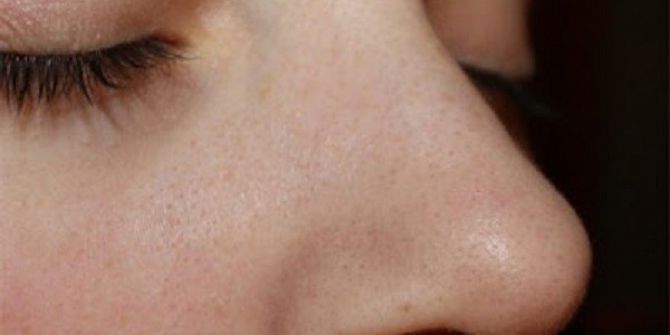 Burun Tıkanıklığı Sinüzite Neden Olabiliyor