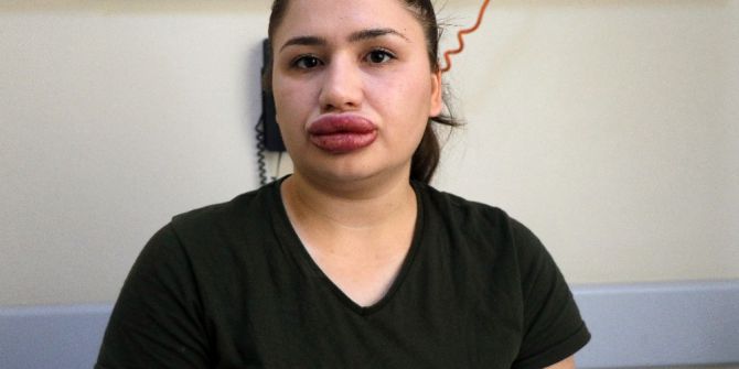 Silikon Faciası Kurbanı Hemşirenin Estetik Uzmanı Kuaför Çıktı
