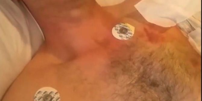 İş Makinesine Kaptırdığı Kolu Yerine Dikilemedi, Yine De Şükretti