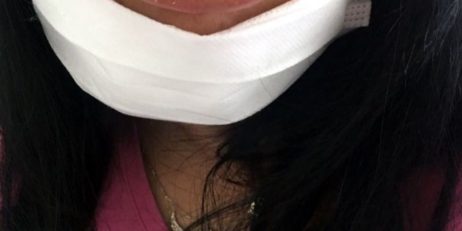 Dudak Faciası Mağdurları Artıyor