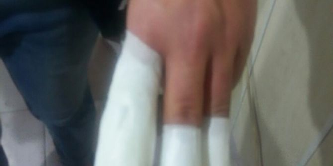 Havai Fişek Elinde Patlayınca Hastanelik Oldu