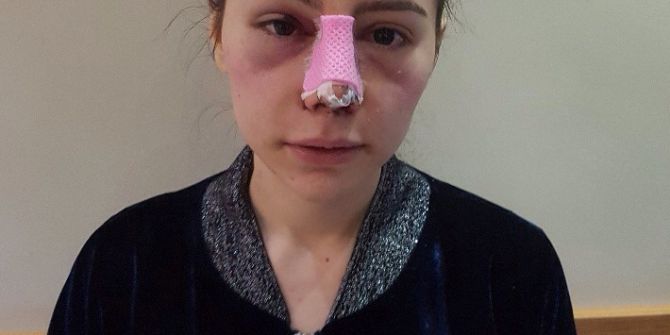 Çaldığı Paralarla Burnuna Estetik Yaptırdı