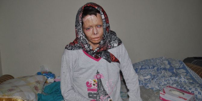 Esad’ın Yaktığı Suriyeli Nuha Türkiye’de Şifa Buluyor