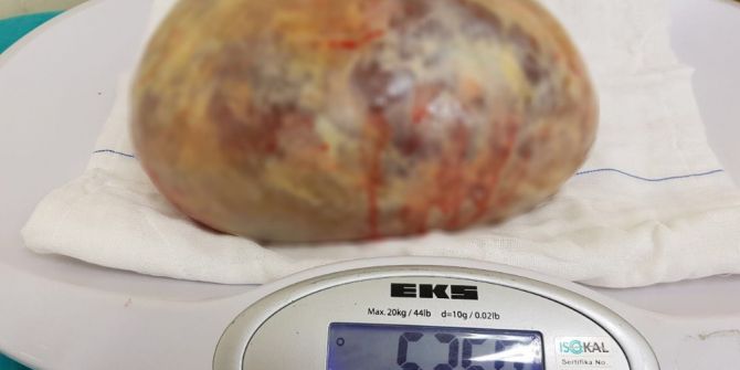 Samsun’da Bir Hastadan 5 Kilo 350 Gram Kist Çıkarıldı