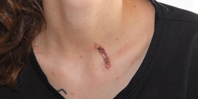 Sokakta Genç Kıza Sigaralı Saldırı