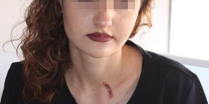 Genç Kızın Boynunda Sigara Söndüren Şüpheli Tutuklandı