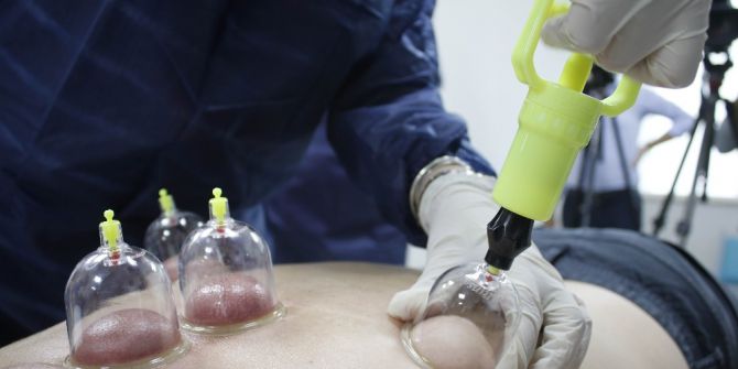 Antalya’da Akapunktur Ve Hacamata Devlet Güvencesi