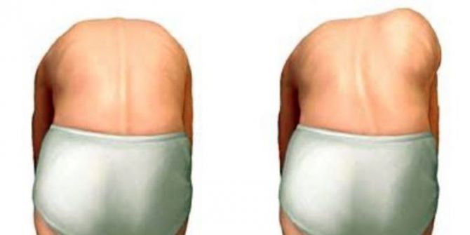 Öğretmenlere Ve Ailelere Skolyoz Uyarısı