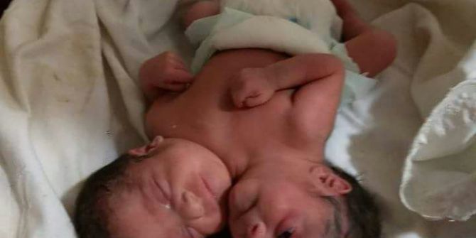 Suriye’de Çift Başlı Bebek Dünyaya Geldi