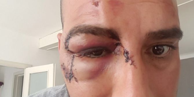 Belçika’da Irkçılar Türk Vatandaşını "Erdoğancı" Diye Darp Etti