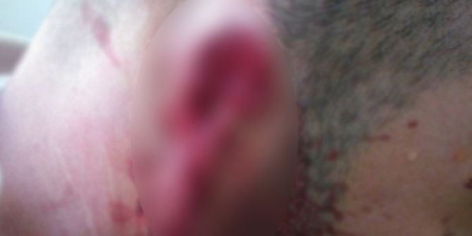 50 Tl İçin Arkadaşının Kulağını Isırarak Kopardığı İddiası