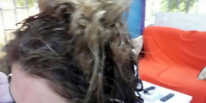 Yanlış Yıkama Ve Kimyasal Yüzünden Saçından Oldu İddiası