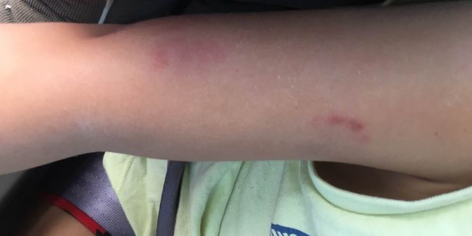 2 Yaşındaki Çocuğa Kreşte Darp