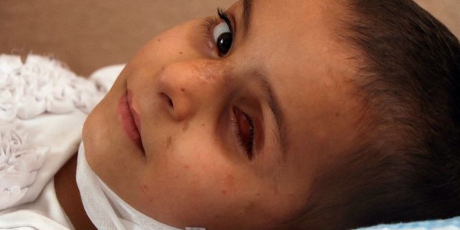 Esad Güçlerinin Attığı Bombanın Kör Ettiği Minik Yasmin’in Yardım Çığlığı