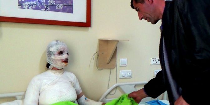 Üzerine Kaynar Su Dökülen 8 Çocuk Annesi Kadın Yandı