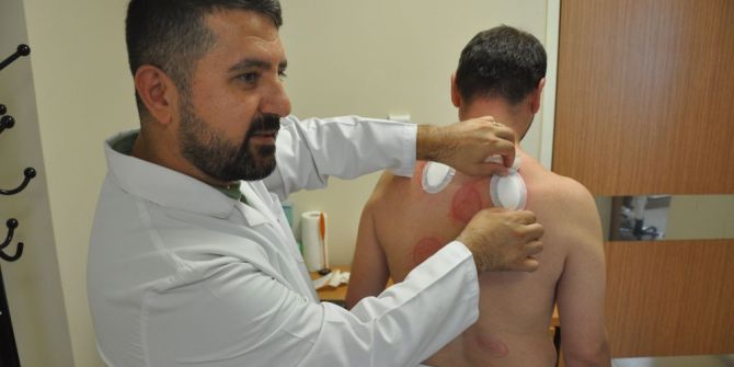 Devlet Hastanesinde Hacamat Ve Akupunktur Polikliniği Açıldı