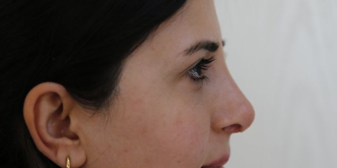 28 Yıldır Nefes Alma Sorunu Yaşayan Azeri Sağlığına Denizli’de Kavuştu