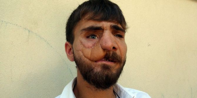 25 Yaşında 38 Ameliyat Geçirdi