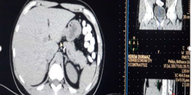 Faslı Uyuşturucu Kuryesinin Midesinden 78 Adet Kapsül Uyuşturucu Çıktı